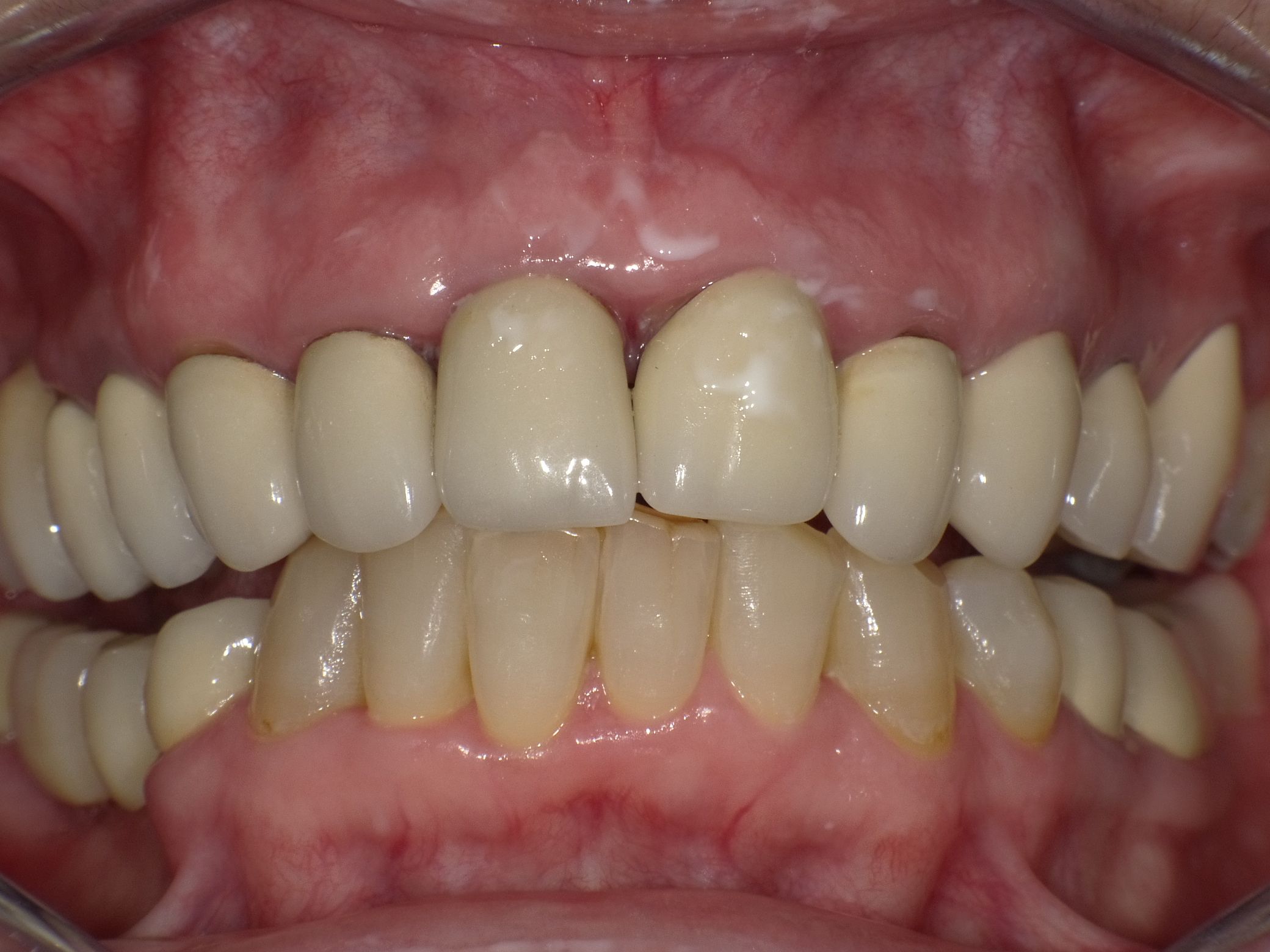 Unschöne Kronen aus Metallkeramik mit Zahnfleischproblematik